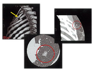 (写真：左から)肋骨骨折、肺癌、乳癌