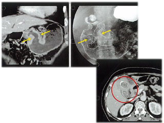 (写真：左から)胃癌(左:CT MPR冠状断像、右:上部消化管造影)、胆石胆嚢炎